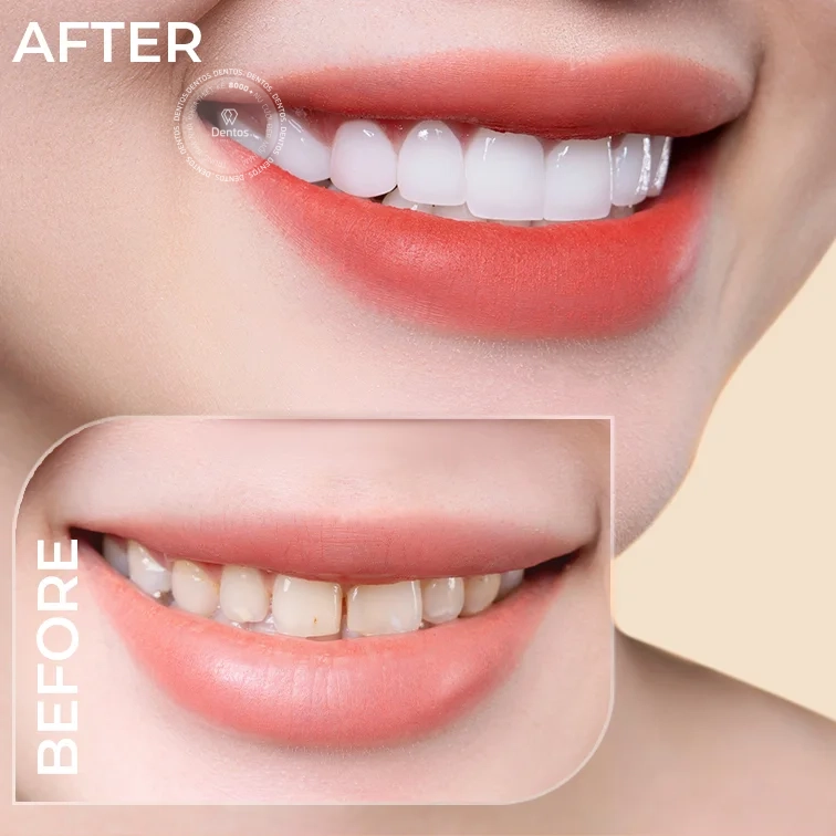 Nha khoa Dentos - Địa chỉ bọc răng sứ uy tín tại TP.HCM